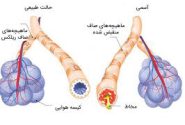 تاثیرات شگفت انگیز فعالیت ورزشی بر بیماری آسم