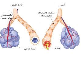 تاثیرات شگفت انگیز فعالیت ورزشی بر بیماری آسم